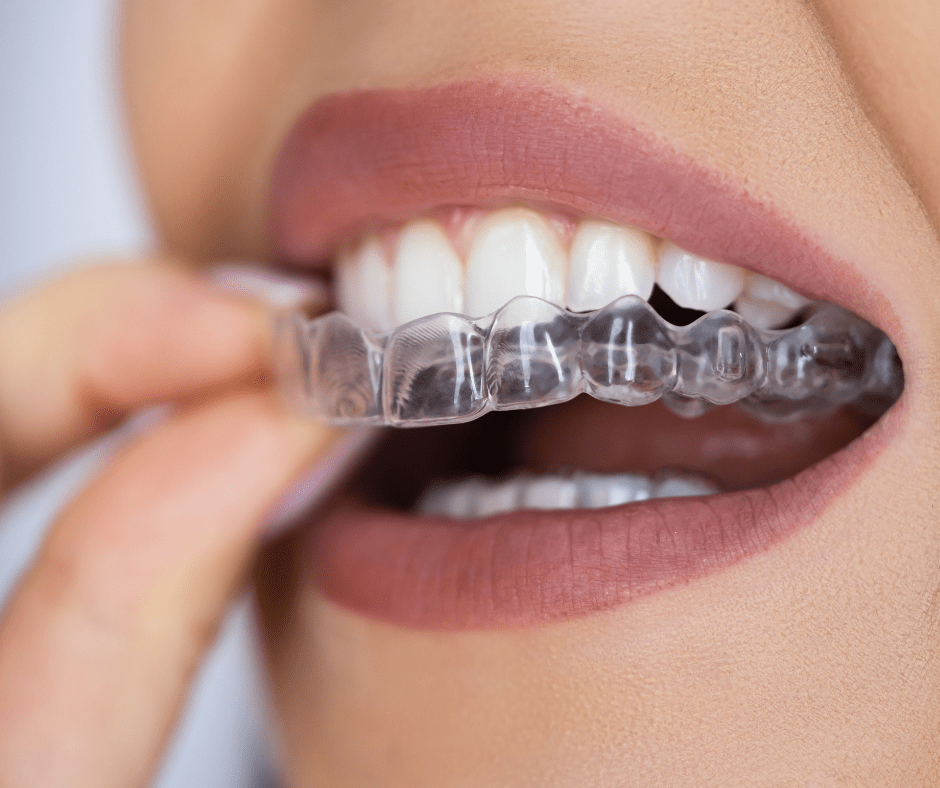 Aparat Dentar de Contenție