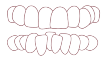 Înghesuire dentară